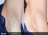 Laser Armpit Hair Removal Side Effects Pictures
