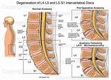 L4 And L5 Disc Bulge Treatment Pictures