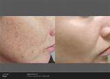 Laser Treatment For Moles On Face Side Effects Photos