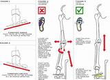 Rearfoot Varus Treatment Pictures