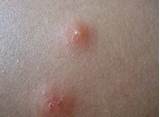 Treatment For Bed Bugs And Scabies Pictures