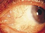 Images of Conjunctival Pyogenic Granuloma Treatment