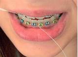 Pictures of Orthodontic Flossers For Braces