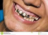Gold Teeth Dentist