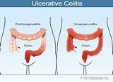 Proctitis Medication Pictures