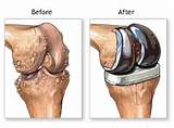 Muscle Strengthening After Hip Replacement Pictures