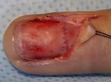 Images of Toe Nail Repair