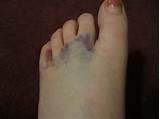 Broken Toe Doctor Images