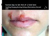 How To Cover A Cold Sore Scab With Makeup Pictures