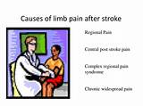 Central Post Stroke Pain Syndrome Treatment Photos