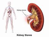 Pictures of Natural Treatment For Kidney Health