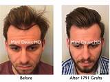 Best Hair Loss Treatment Reddit Pictures