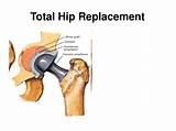 Hip Replacement Recovery Timeline Elderly