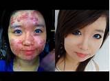 Makeup For People With Acne Pictures
