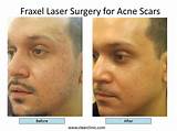 Acne Scar Treatment Nyc Pictures