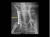 Images of Pelvic Stress Fracture Recovery