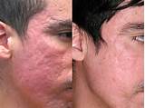 Pictures of Best Acne Scar Fade Treatment