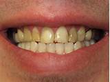 Silver Treatment For Cavities Photos