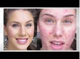 Makeup For Acne Scarred Skin Pictures