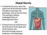Hiatal Hernia Diagnosis And Treatment