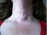 Images of Recovery After Thyroidectomy