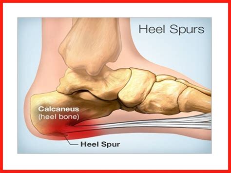 Foot Pain In Heel And Side Of Foot