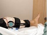 Photos of How Long Is Recovery After Acl Surgery