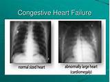 Class 4 Congestive Heart Failure Photos