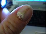 Images of Bad Fingernails Treatment