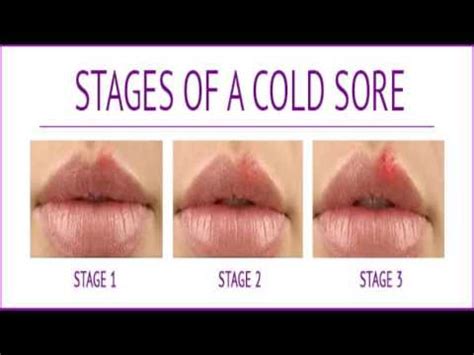 Can Cold Sores Be In Your Mouth Pictures