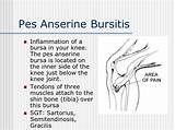 Photos of Pes Anserine Bursitis Treatment Exercises