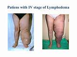 Photos of Stage 3 Lymphedema Treatment