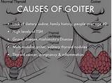 Goiter Treatment Pictures