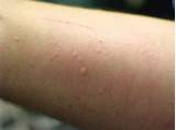 Hives Doctor Treatment Pictures