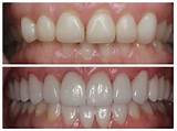 Dental Bonding Before And After Pics Photos