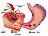 Best Treatment For Chronic Halitosis