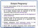 Images of Single Fallopian Tube Pregnancy