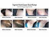 Photos of Ingrown Hair Abscess Treatment