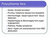 Polycythemia Vera Management Images