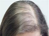 Prp Treatment For Alopecia Pictures