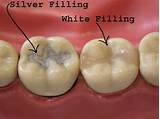 Photos of Silver Treatment For Cavities