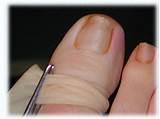 Images of Foot Doctor To Remove Ingrown Toenail