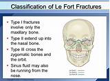 Images of Le Fort Fracture Treatment