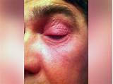 Pictures of Severe Eye Allergy Treatment