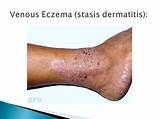 Photos of Venous Eczema Treatment