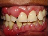 Pictures of Dog Gum Disease Natural Treatment