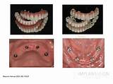 Permanent Dental Implants Procedure Pictures