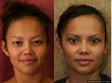 Pictures of Asian Blepharoplasty Recovery
