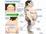 Images of Cushing Syndrome Medication