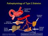 Type 2 Diabetes Medical Definition
